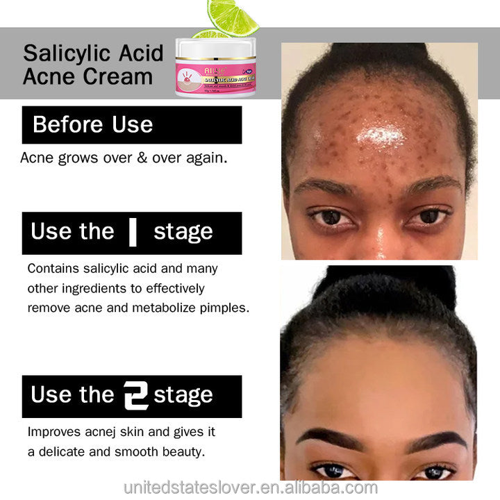 High Quality Facial Moisturizer Salicylic Acid Acne Scar Removal Cream Best Organic Anti Acne Face Cream