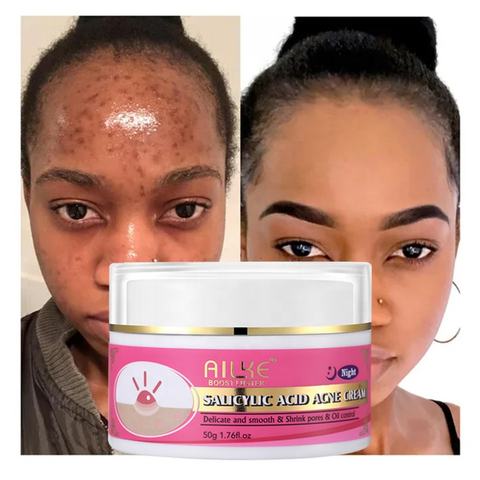 High Quality Facial Moisturizer Salicylic Acid Acne Scar Removal Cream Best Organic Anti Acne Face Cream